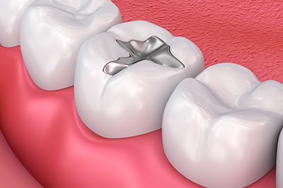 Smile Philosophy Dental Care | Ceramic Crowns, Oral Cancer Screening and Implant Dentistry
