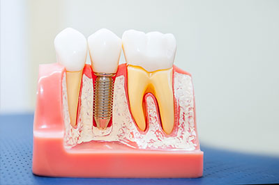 Smile Philosophy Dental Care | Crowns  amp  Caps, Dental Bridges and Implant Restorations