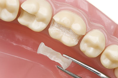 Smile Philosophy Dental Care | Crowns  amp  Caps, Periodontal Treatment and Ceramic Crowns