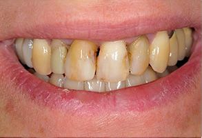 Smile Philosophy Dental Care | Crowns  amp  Caps, Periodontal Treatment and Root Canals