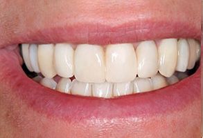 Smile Philosophy Dental Care | Implant Dentistry, Implant Restorations and Extractions