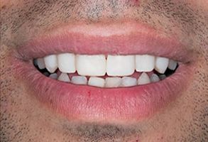 Smile Philosophy Dental Care | Dental Fillings, Crowns  amp  Caps and Implant Restorations