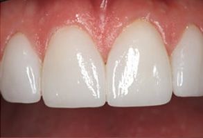 Smile Philosophy Dental Care | Preventative Program, Ceramic Crowns and Implant Dentistry